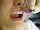 Reinigung der Zahnzwischenr&auml;ume mit Intradentalb&uuml;rstchen